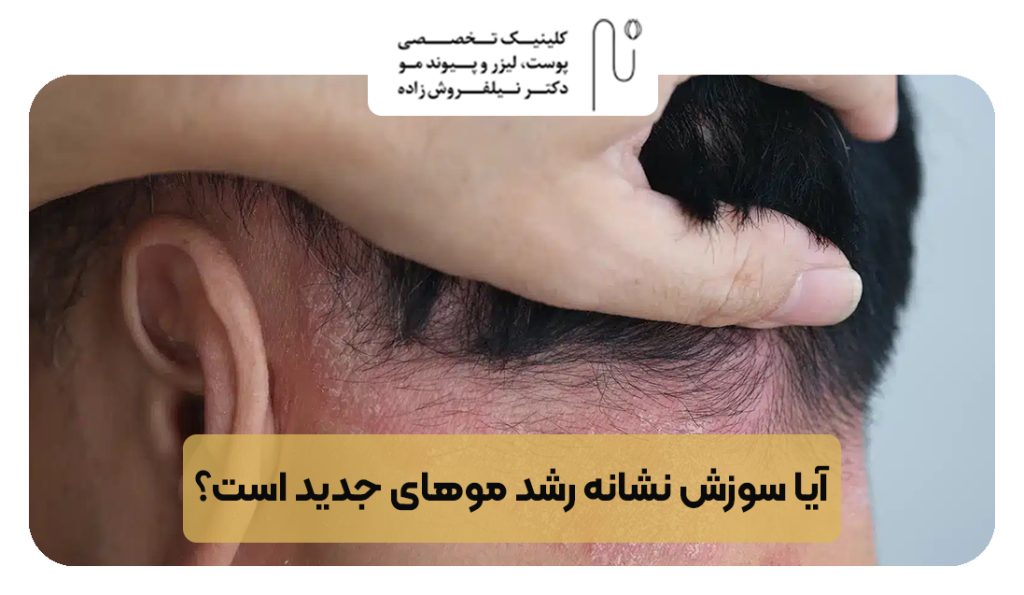 آیا سوزش نشانه رشد موهای جدید است؟ | کلینیک نیلفروش زاده