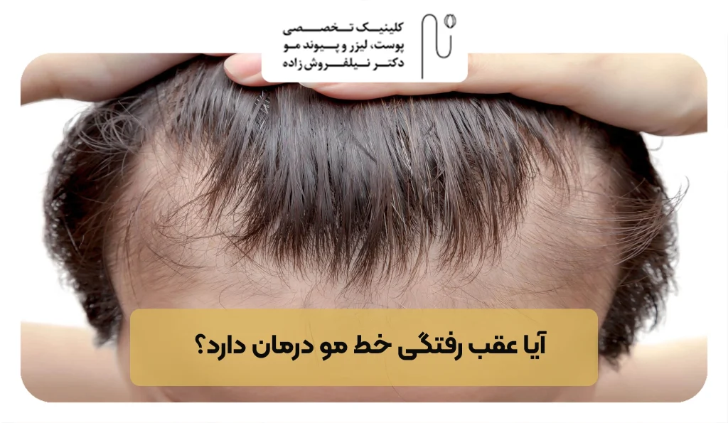 آیا عقب ‌رفتگی خط مو درمان دارد؟ | کلینیک نیلفروش زاده