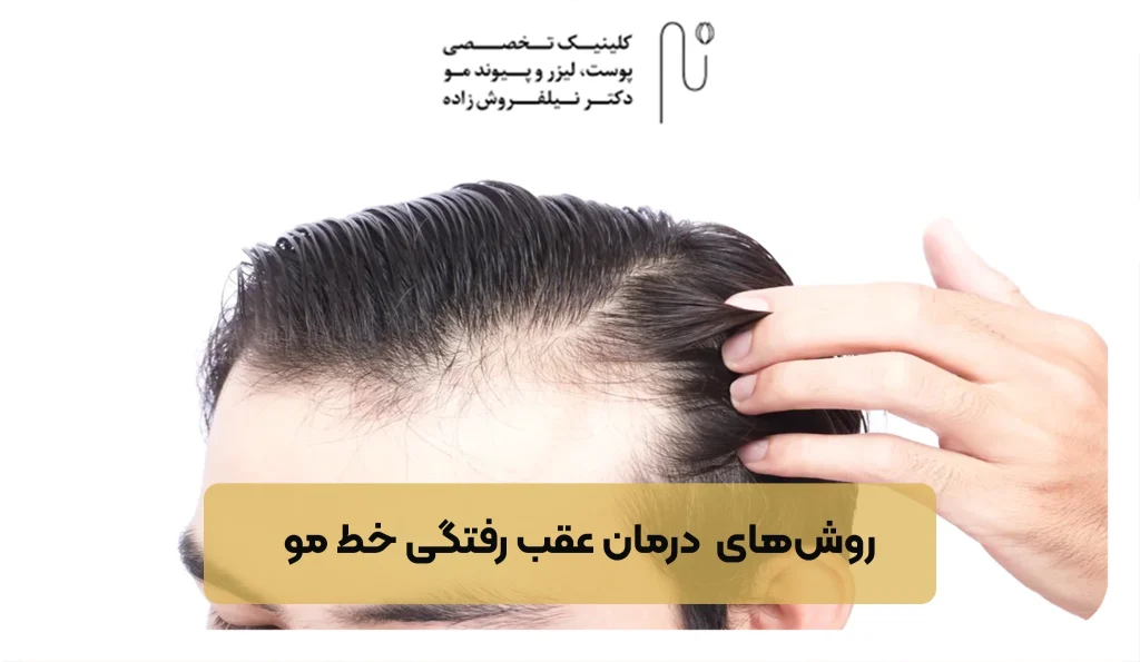 روش‌های  درمان عقب ‌رفتگی خط مو | کلینیک نیلفروش زاده