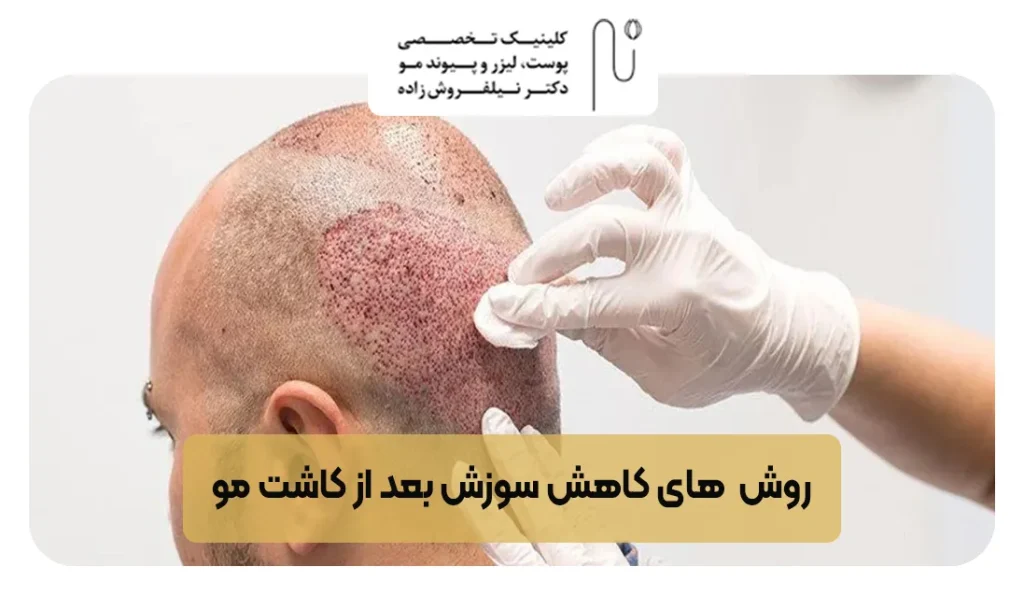 روش های کاهش سوزش بعد از کاشت مو | کلینیک نیلفروش زاده