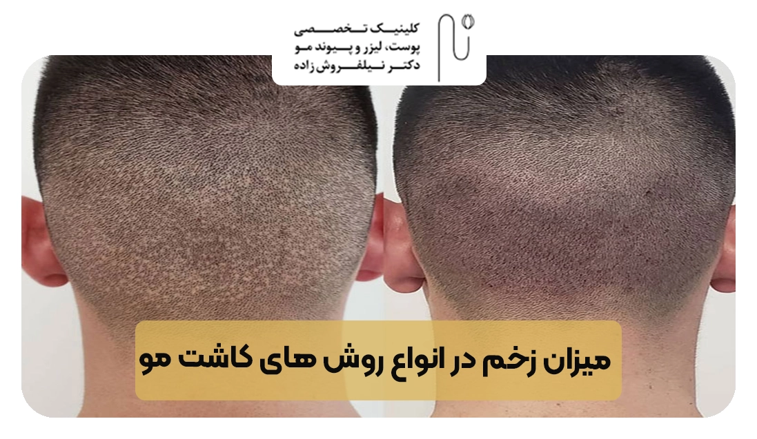 میزان زخم در انواع روش های کاشت مو | کلینیک نیلفروش زاده