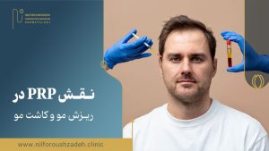 نقش PRP در ریزش مو و کاشت مو