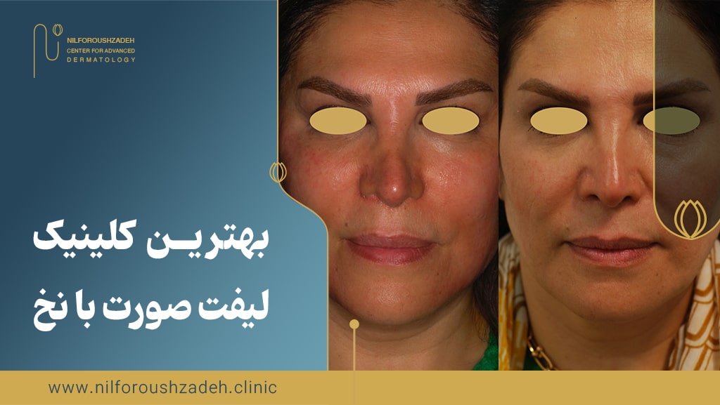کلینیک لیفت صورت با نخ