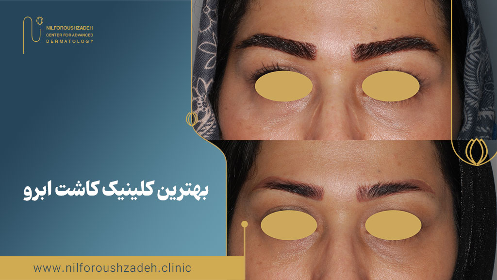 بهترین کلینیک کاشت ابرو