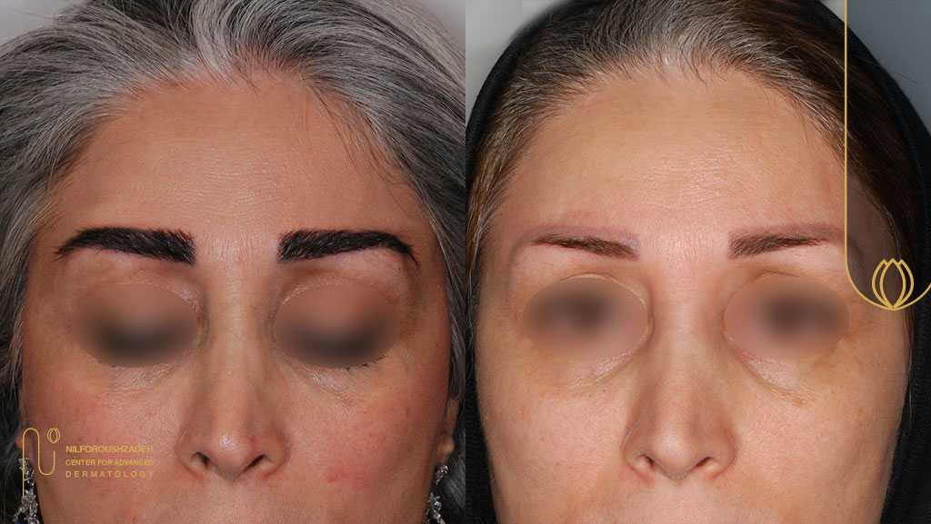 ۷ معیار کلیدی انتخاب بهترین دکتر کاشت ابرو