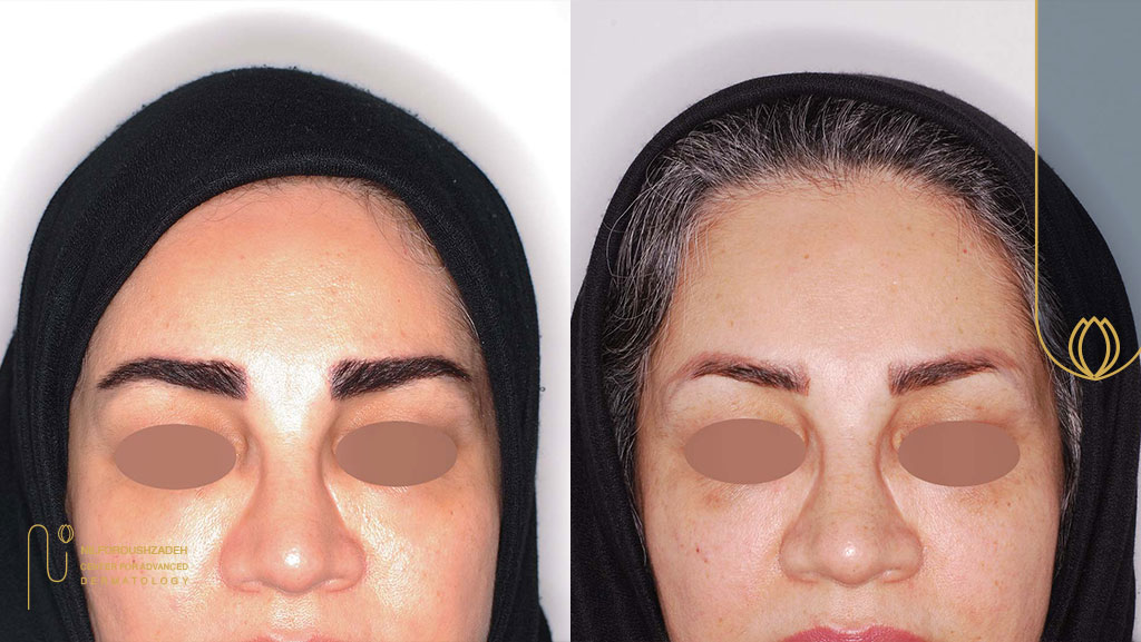 روند کاشت ابرو نزد بهترین دکتر چگونه است؟