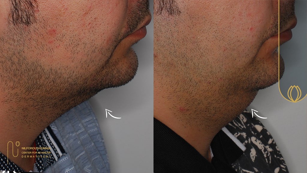 اندولیفت تهران کلینیک نیل فروش زاده