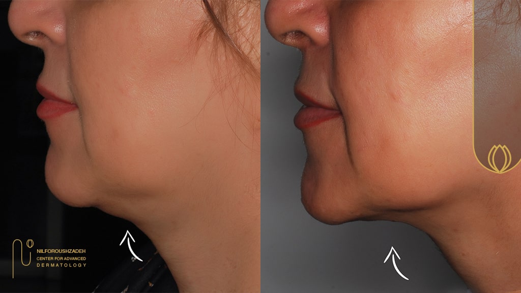 اندولیفت تهران کلینیک نیل فروش زاده