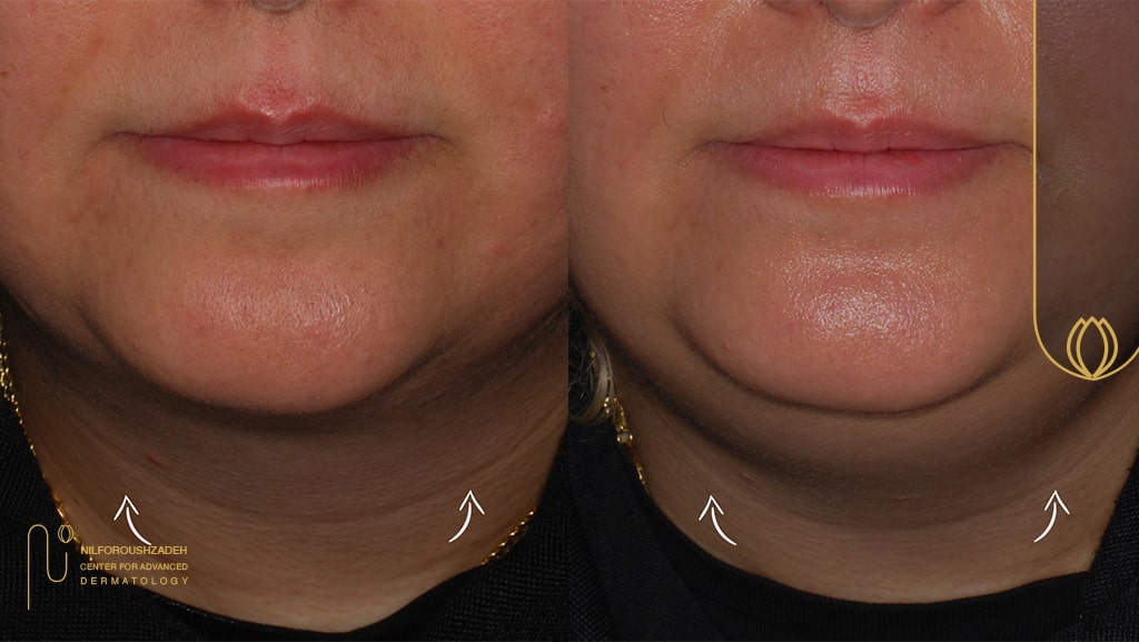 اندولیفت تهران کلینیک نیل فروش زاده