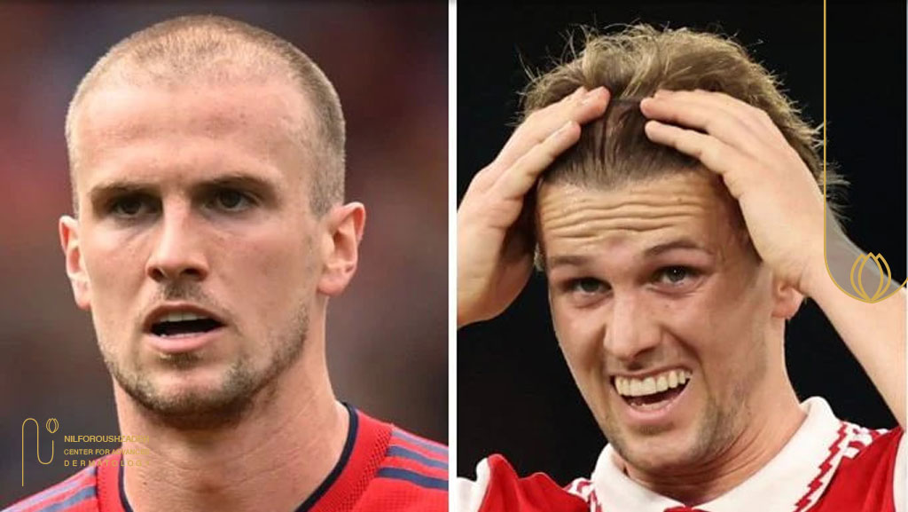چرا فوتبالیستهای مشهور به کاشت مو روی میآورند؟