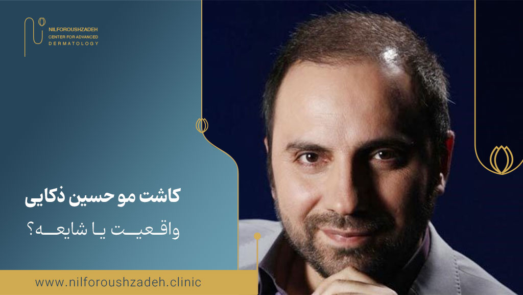 کاشت مو حسین ذکایی