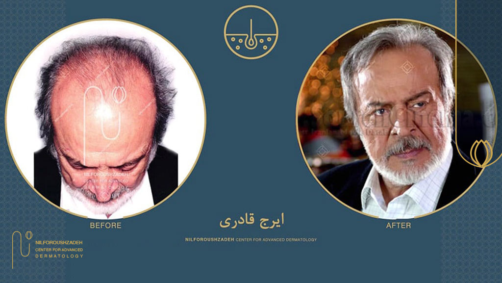 راز ماندگاری کاشت مو عباس قادری چیست؟