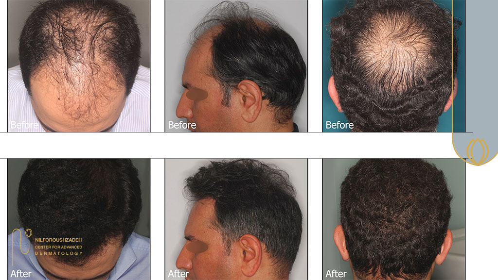 دکتر کاشت موی ایرج قادری چه کسی است؟