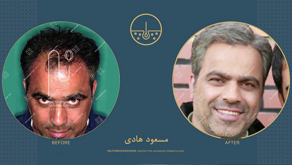 آیا کاشت موی مسعود هادی طبیعی بود؟