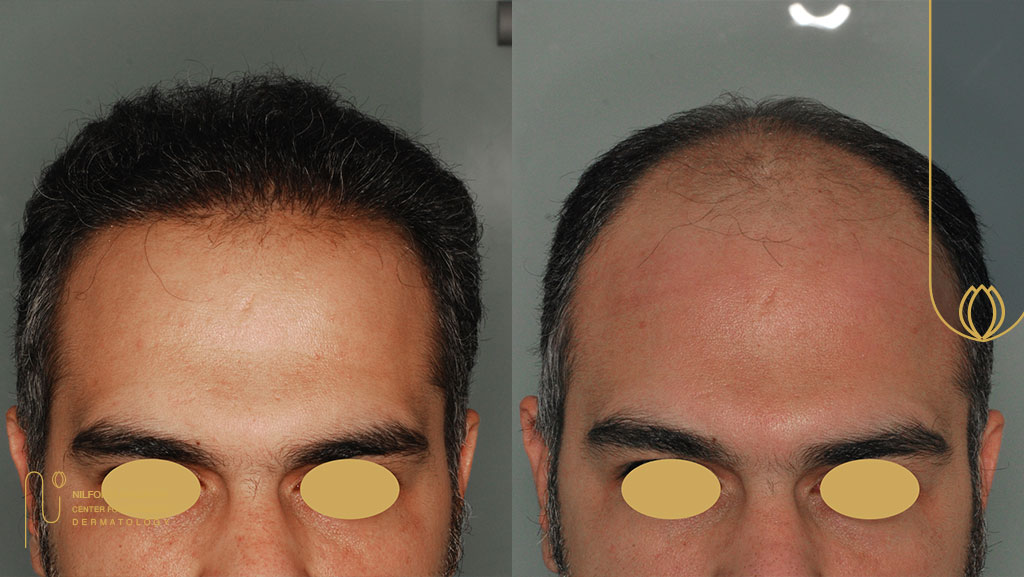 روش کاشت موی مسعود هادی چه بوده است؟