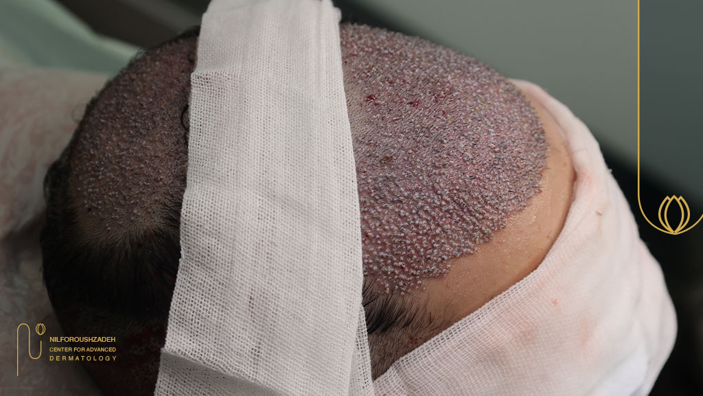 کاشت موی ترکیبی مناسب چه کسانی است؟