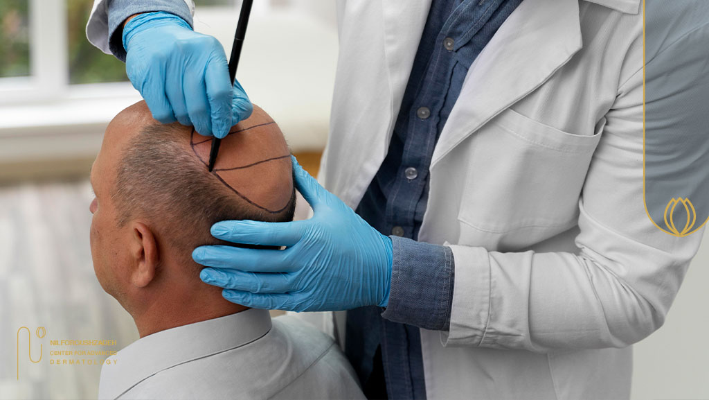 دوره نقاهت کاشت مو ترکیبی چقدر است؟