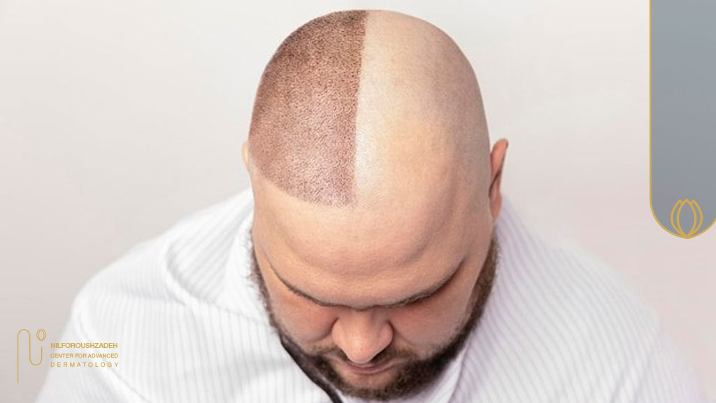 آیا ظاهر سر بعد از کاشت مو در طاسی کامل کم پشت به نظر می رسد؟