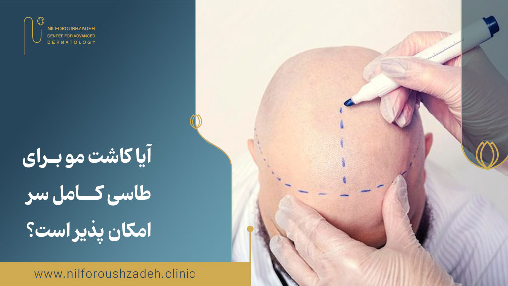 آیا کاشت مو برای طاسی کامل سر امکان پذیر است؟