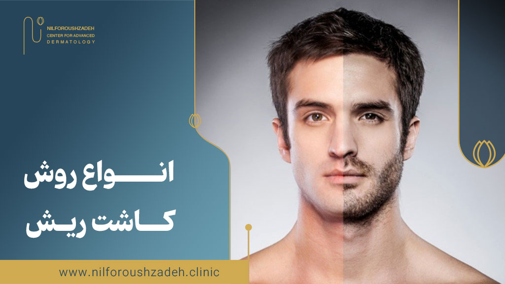 انواع روش کاشت ریش