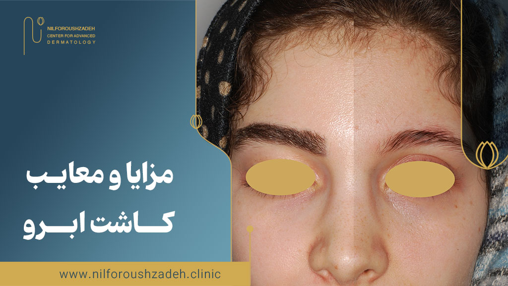 مزایا و معایب کاشت ابرو