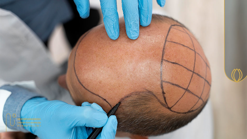 چرا مجریان تلویزیونی به کاشت مو روی میآورند؟