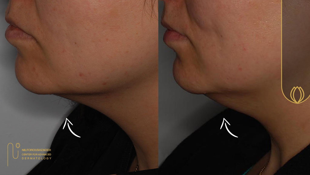 درمان غبغب با اندولیفت