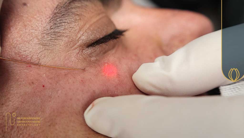 اندولیفت برای پوست چرب