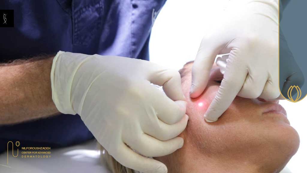 اندولیفت برای پوست افتاده