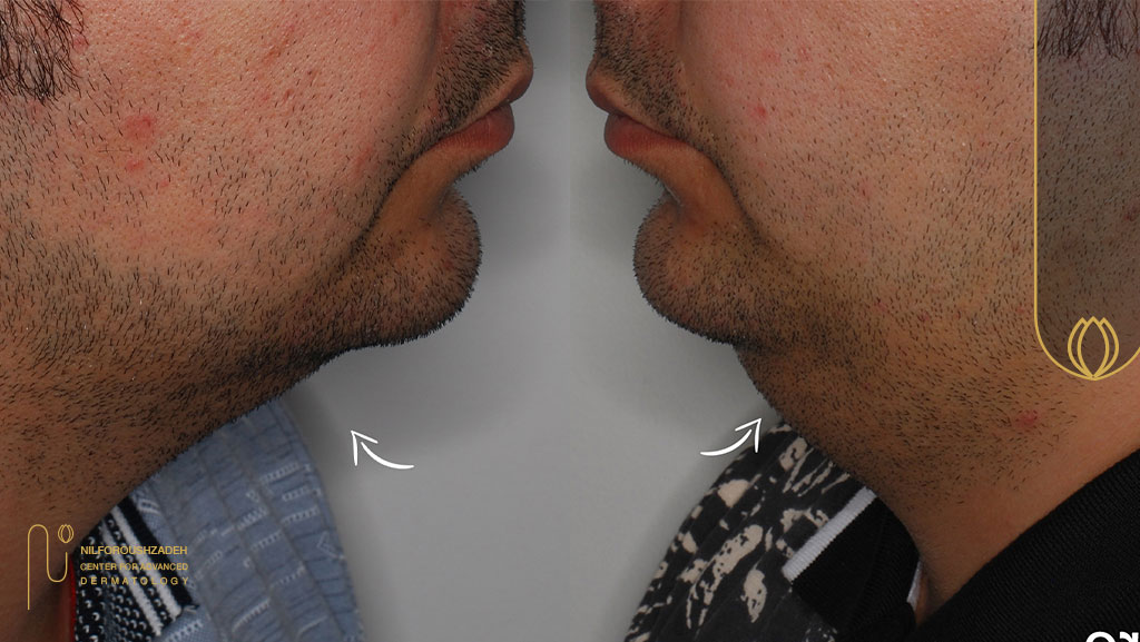 رفع غبغب با اندولیفت