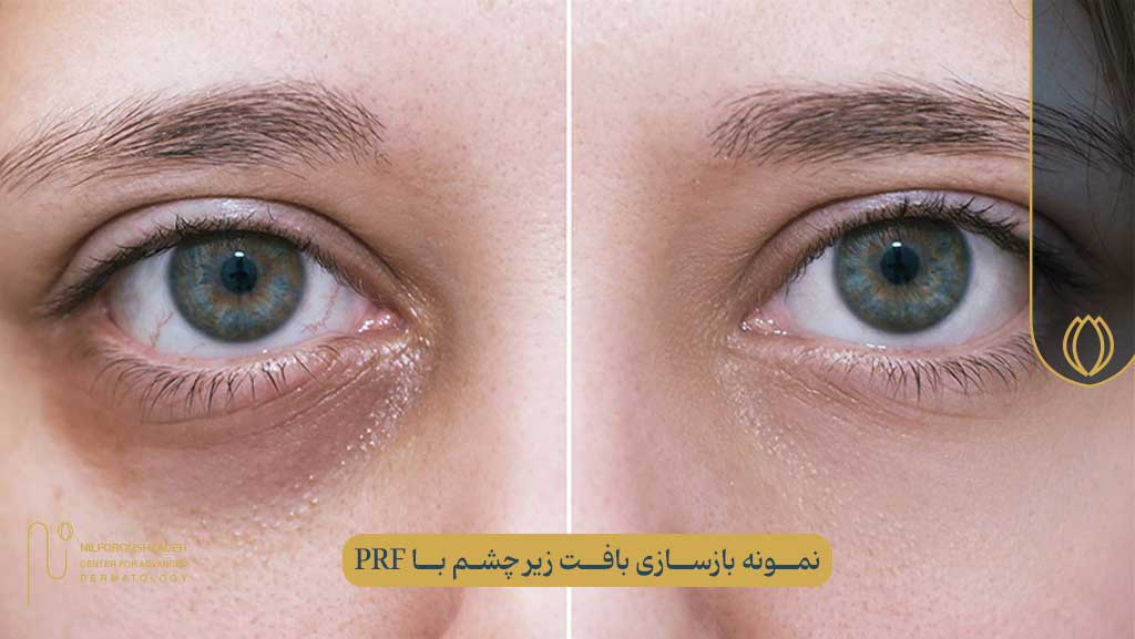 عکس قبل و بعد پی آر اف (PRF) برای زیر چشم