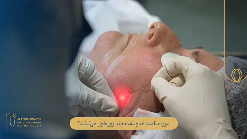 دوره نقاهت اندولیفت چند روز طول میکشد؟