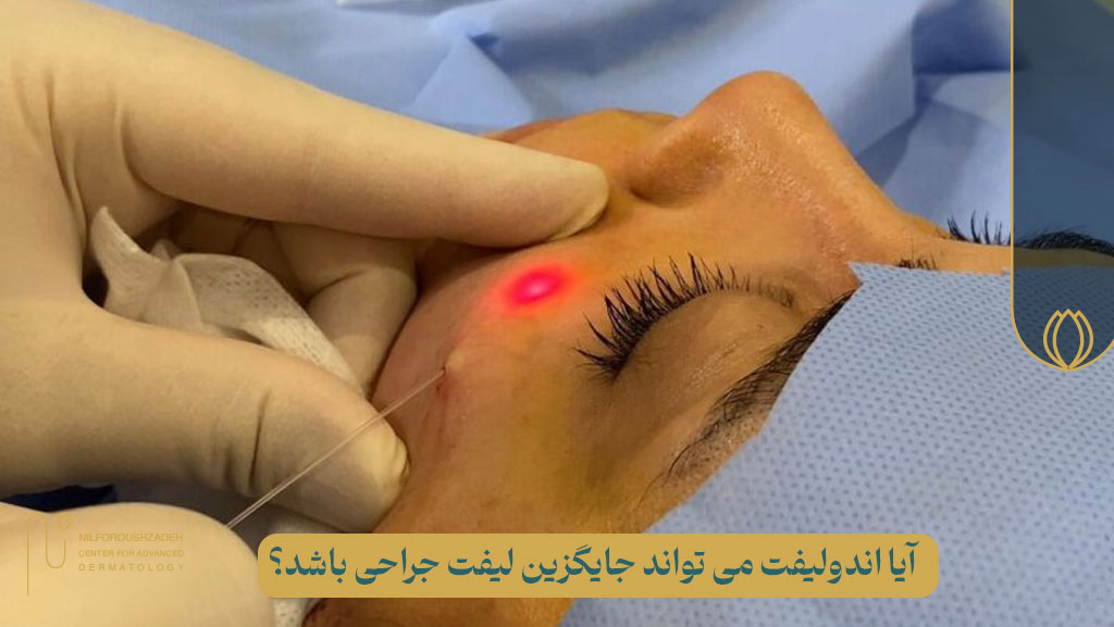 آیا اندولیفت جایگزین لیفت جراحی است؟