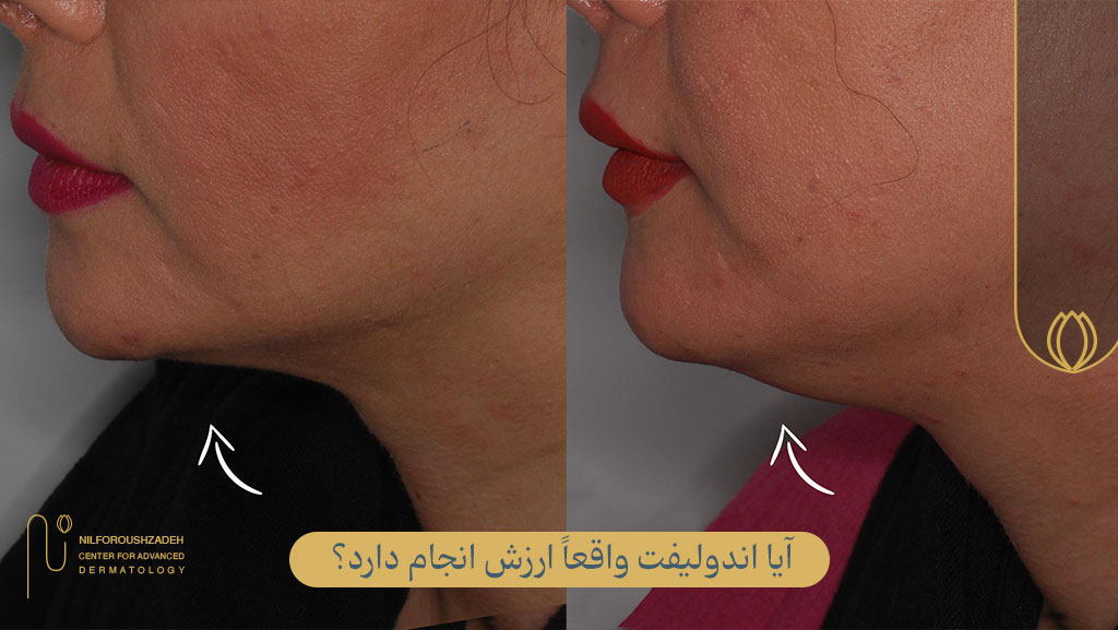 آیا اندولیفت ارزش انجام دادن دارد؟