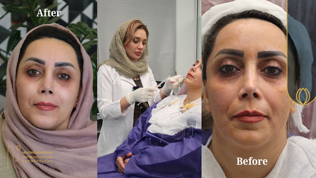کلینیک جردن؛ مرکز مرجع تزریق چربی بازساختی و نانوفت