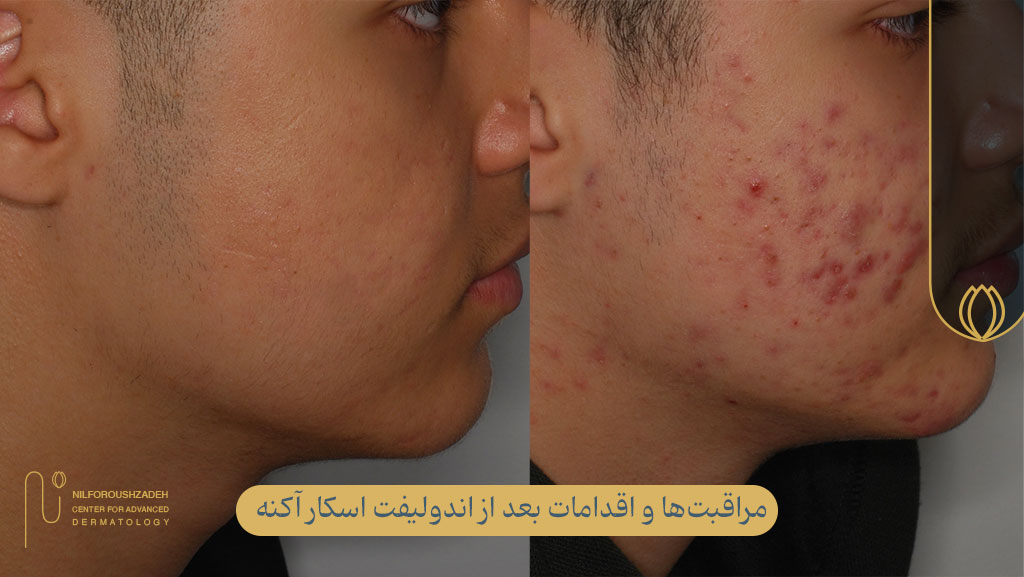 مراقبتها و اقدامات بعد از اندولیفت اسکار آکنه