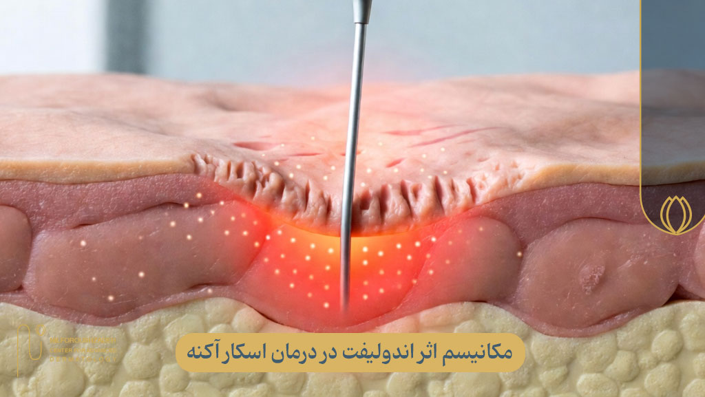 مکانیسم اثر اندولیفت در درمان اسکار