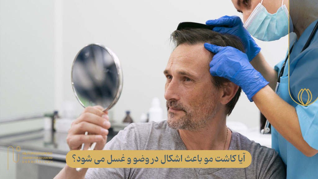 آیا موی کاشته شده باعث اشکال در وضو و غسل میشود؟