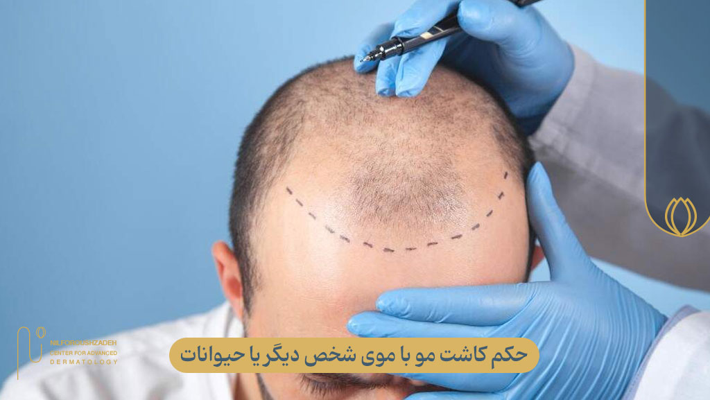 حکم شرعی کاشت مو با موی شخص دیگر یا حیوانات
