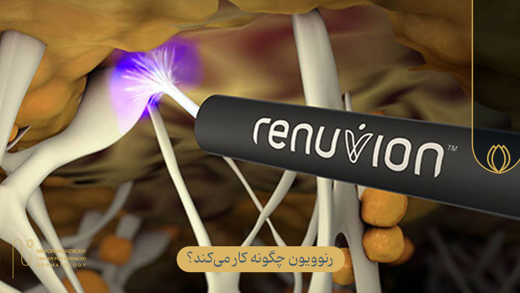 رنوویون چگونه کار میکند؟ (برای درک بهتر عوارض)