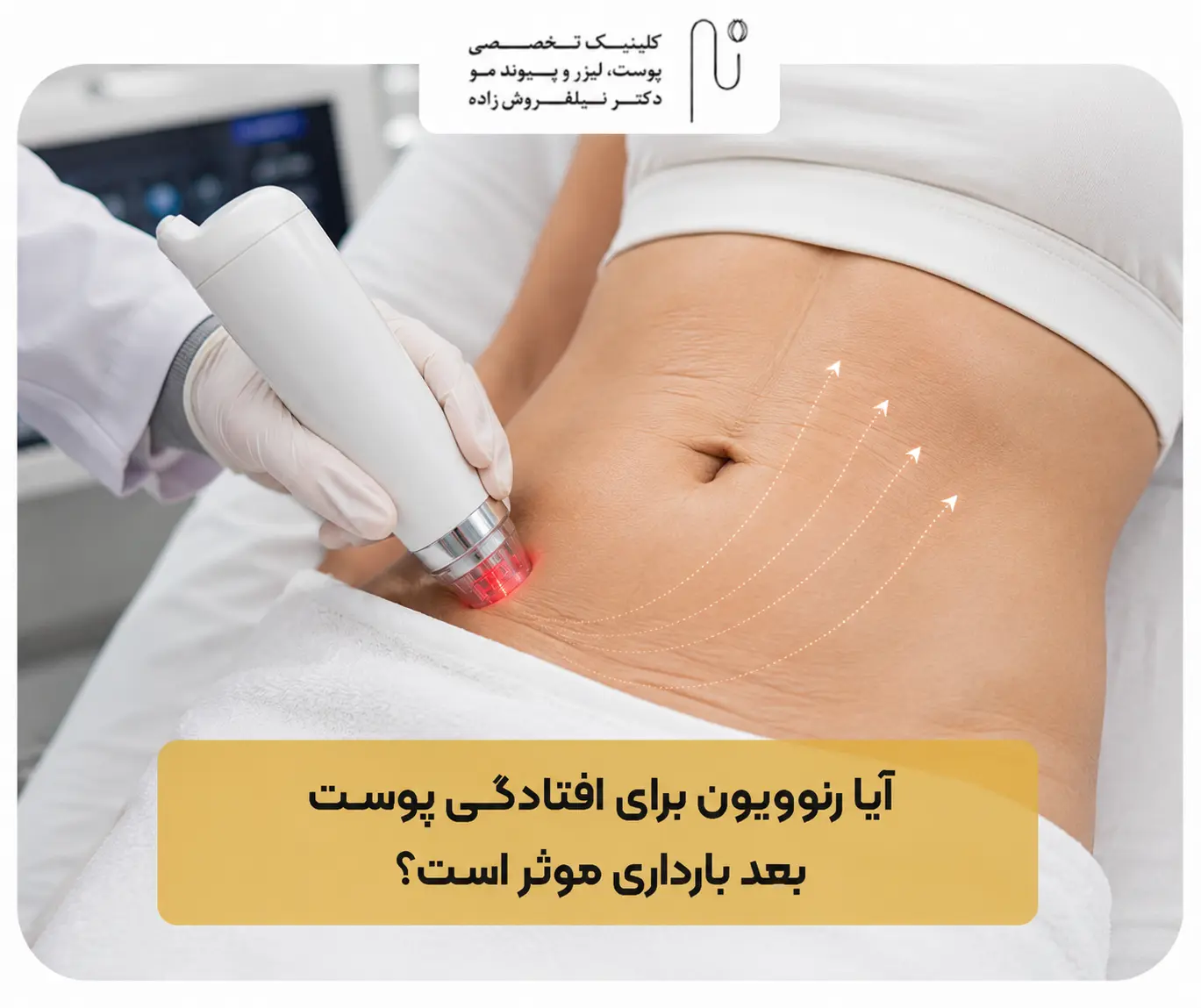 آیا رنوویون برای افتادگی پوست بعد بارداری موثر است؟