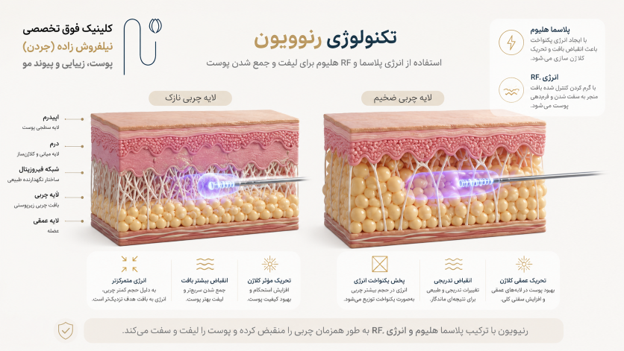 تکنولوژی رنوویون