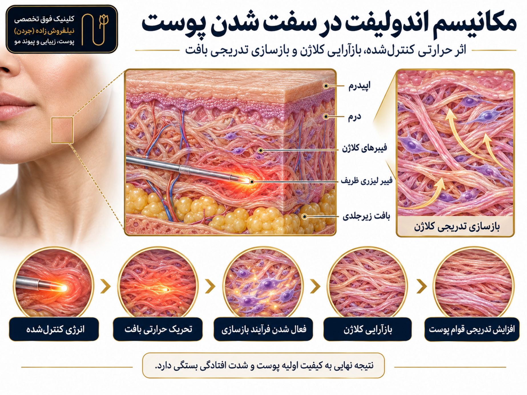 andolift for sagging skin image 02