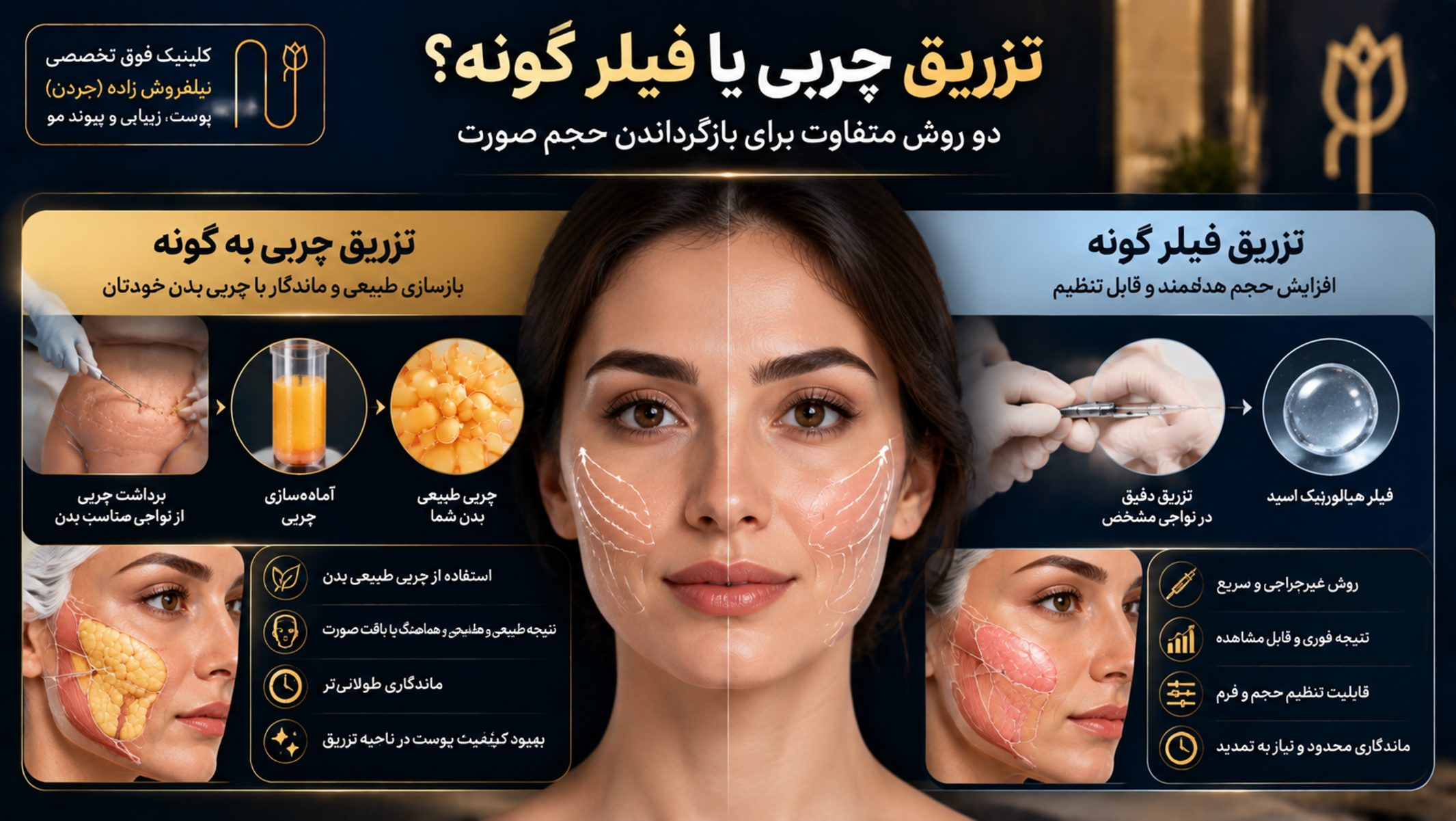 natural cheek fat injection vs fillers image 04