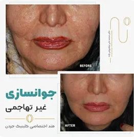 جوتنسازی غیر تهاجمی