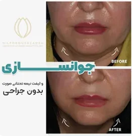 جوانسازی صورت